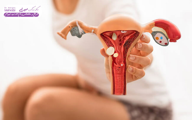 درمان کیست رحم خانگی