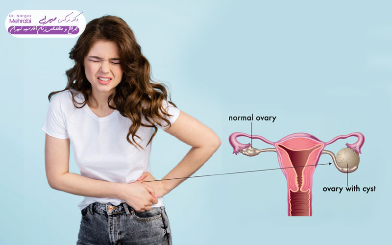 درمان کیست رحم در خانه