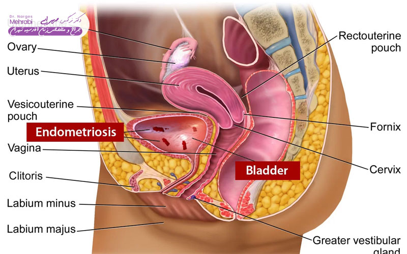 علائم اندومتریوز مثانه