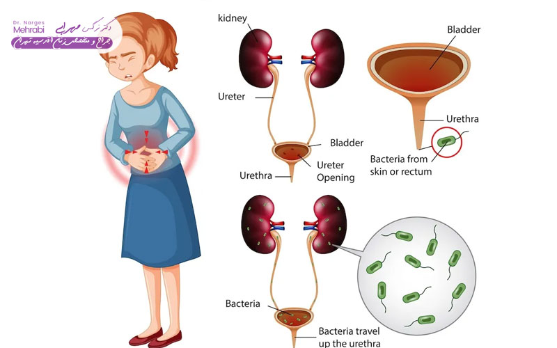 علائم اندومتریوز مثانه 5 علائم مشابه عفونت ادراری