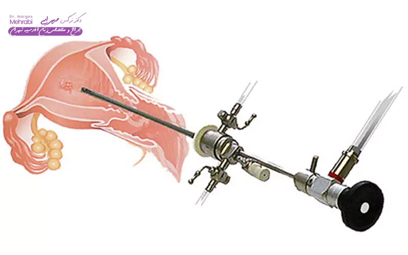 هزینه عمل هیستروسکوپی