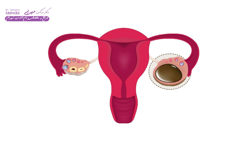 کیست اندومتریوما یا کیست شکلاتی