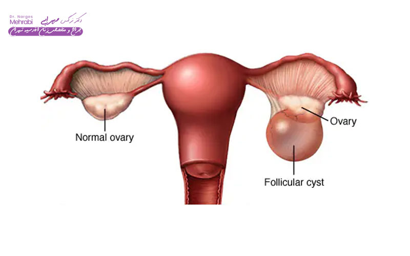 کیست فولیکولار (Follicular Cyst)