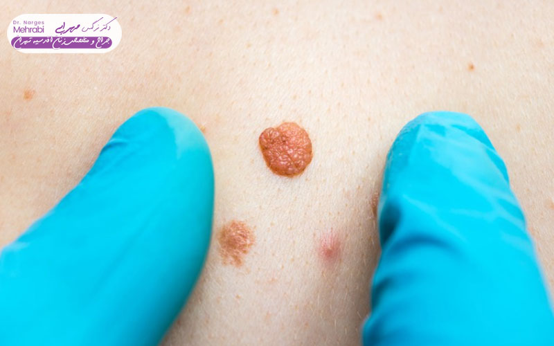 درمان قطعی زگیل تناسلی