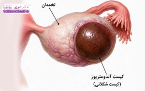 کیست اندومتریوما