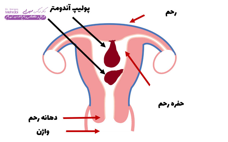 پولیپ آندومتر
